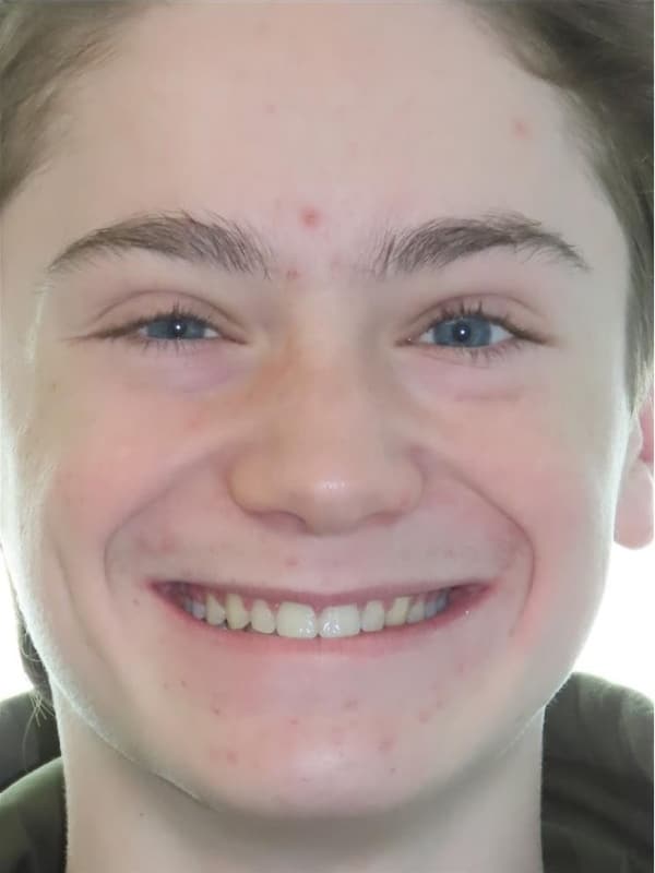 Smile gallery 65 Landon after
