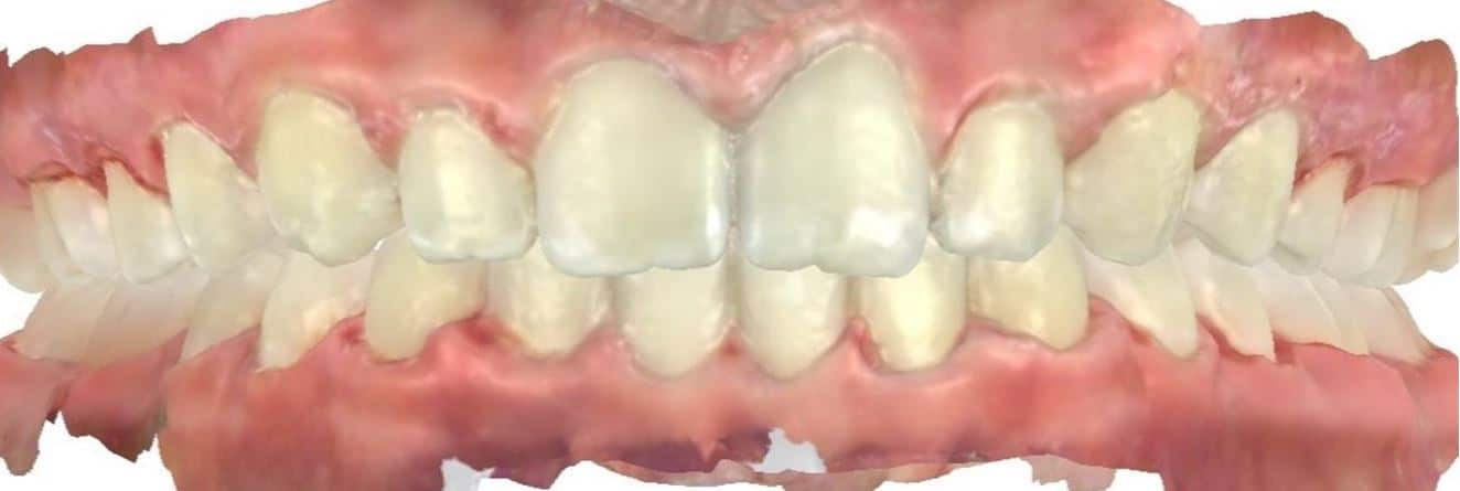 Smile gallery 59 Alyssa after teeth scan