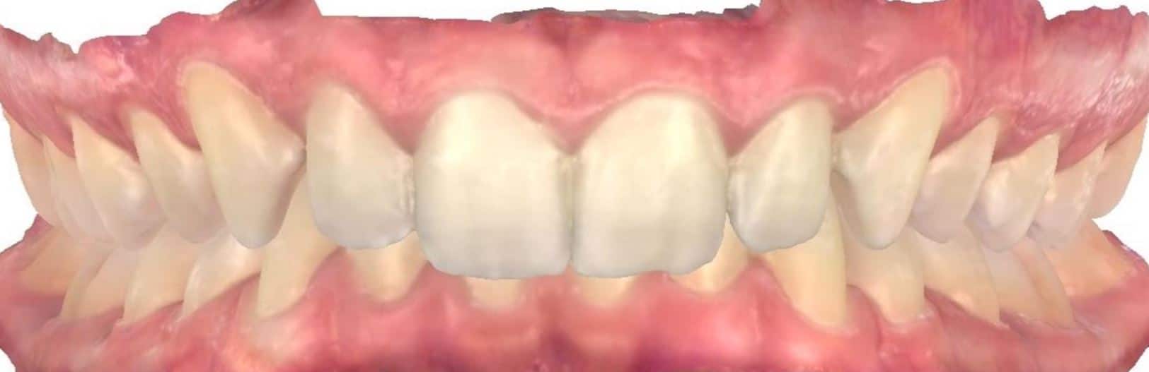 Smile gallery 40 Charlie scan beginning of treatment