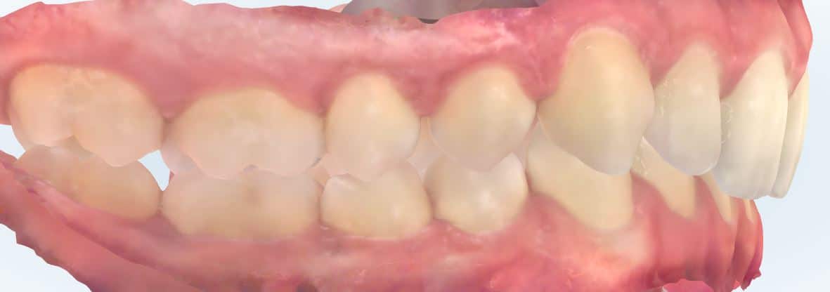 Smile gallery 42 Charlie side scan finish
