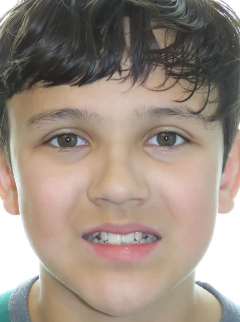 Smile gallery 54 Noah smile start
