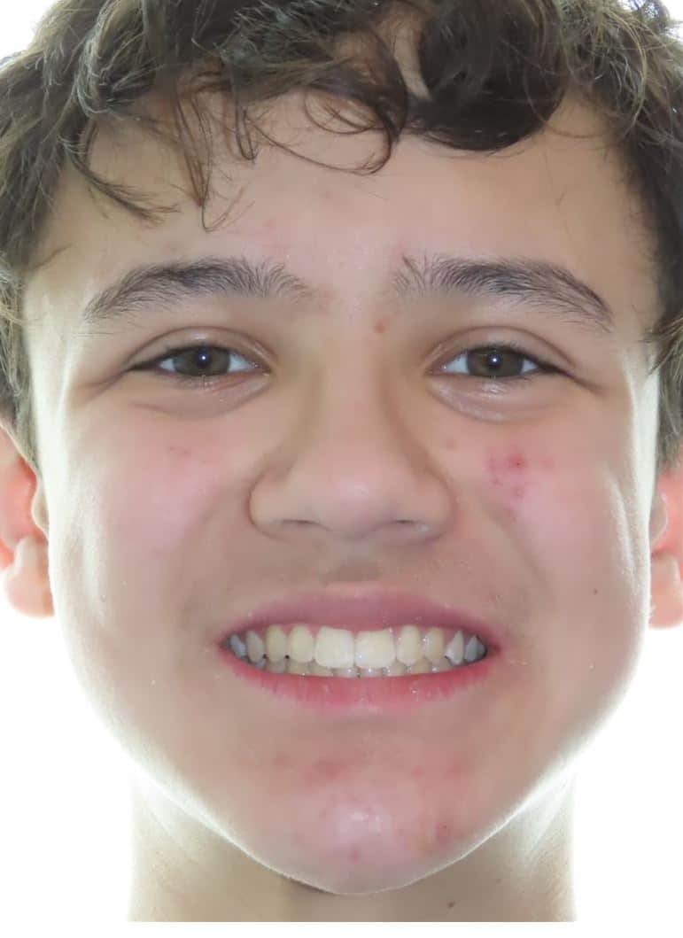 Smile gallery 55 Noah smile finish