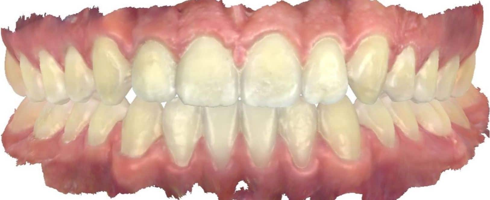Smile gallery 37 Ryan after scan