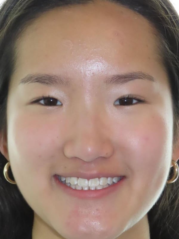 Smile gallery 47 Madeline smile finish