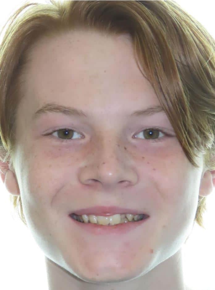 Smile gallery 24 Cade before jfo treatment