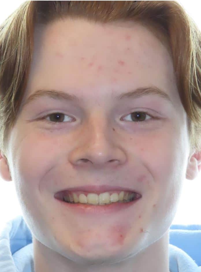 Smile gallery 25 Cade after jfo treatment