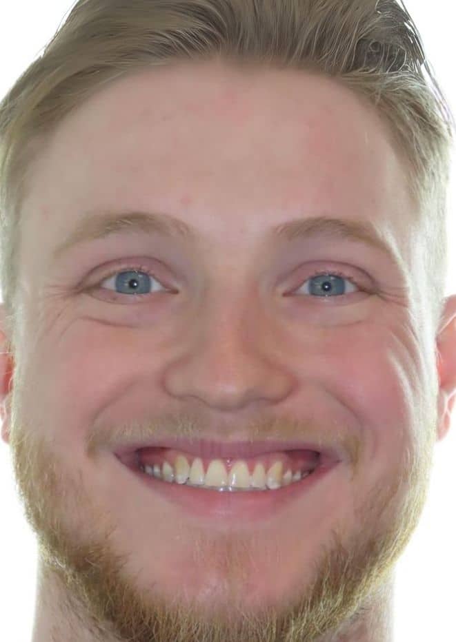 Smile gallery 27 Travis after jfo treatment
