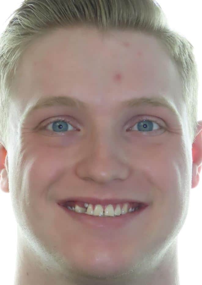Smile gallery 26 Travis before jfo treatment