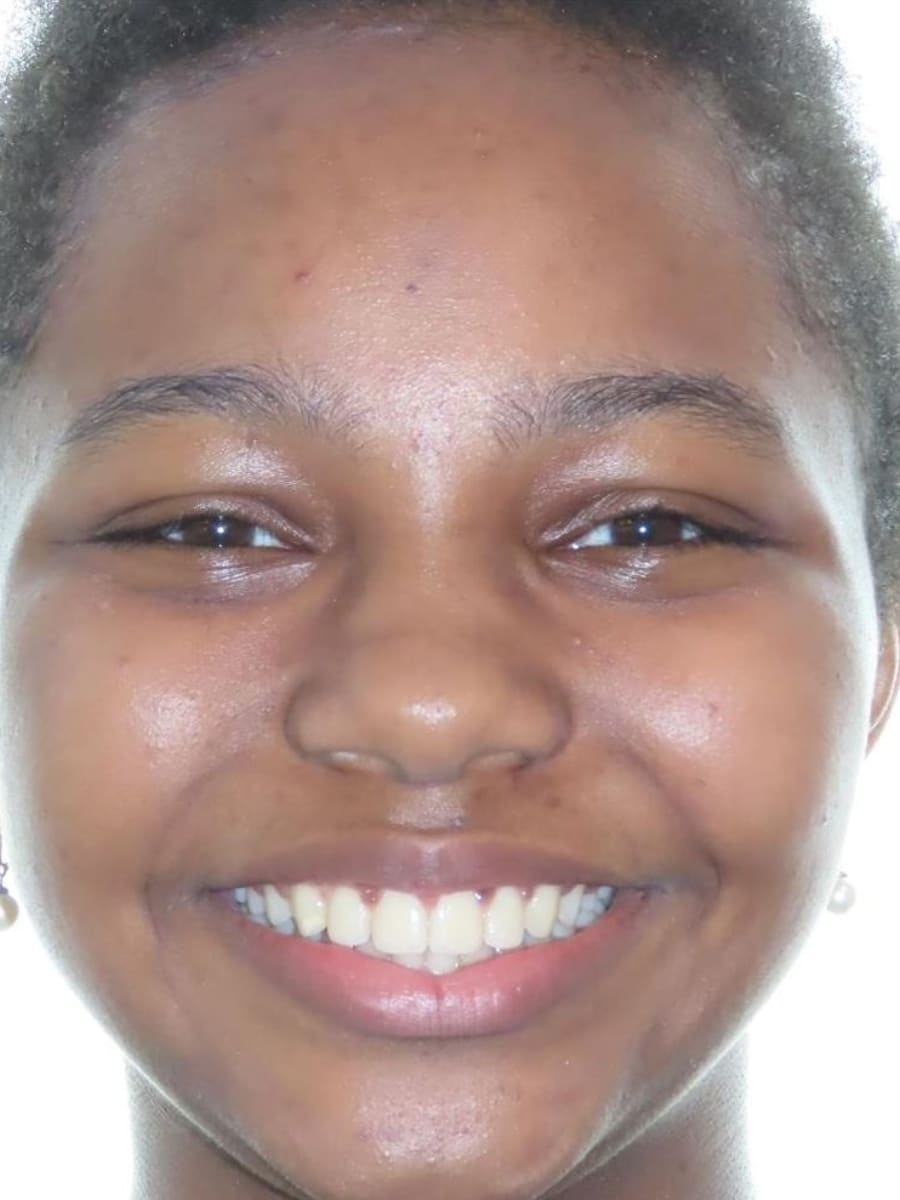 Smile gallery 11 Ella final smile