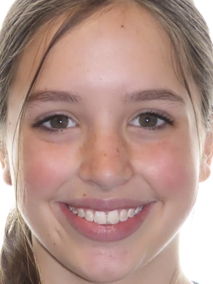 Smile gallery 3 Caroline-smile-final