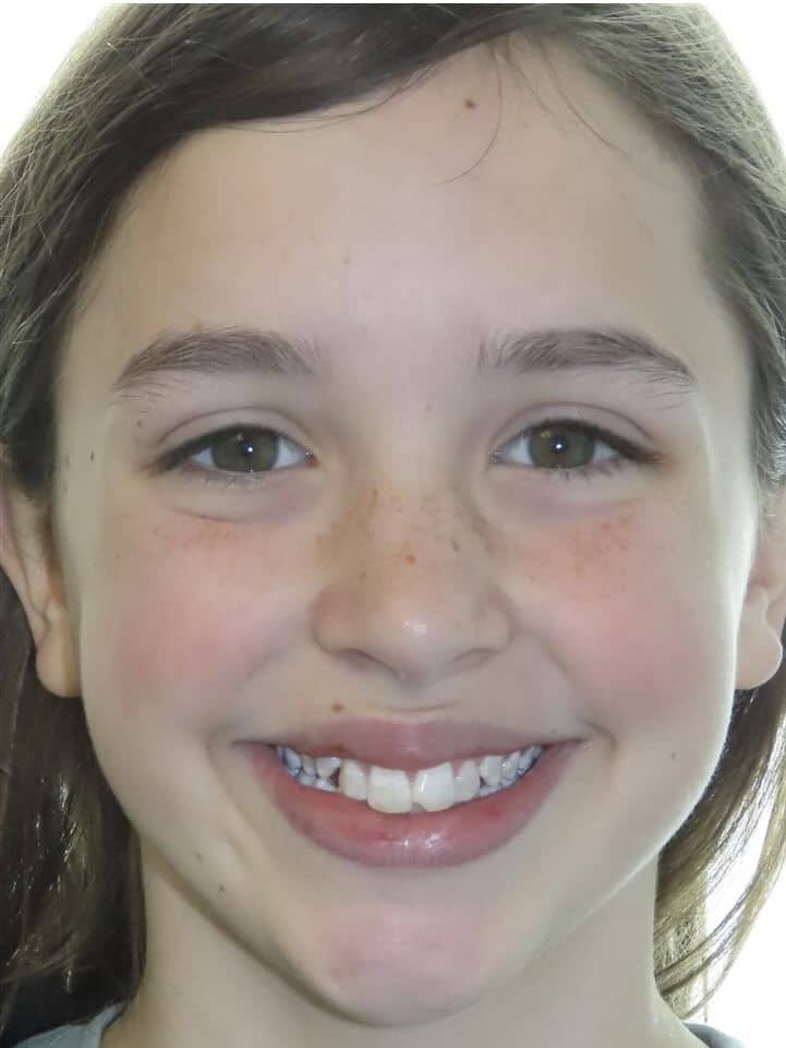 Smile gallery 2 Caroline smile start
