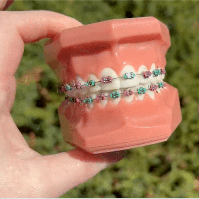 How much braces cost in williamsburg, va? 2 Hand holding a model of braces, representing how much braces cost